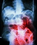 Small Bowel Obstruction.  Film X-ray Abdomen Supine :  Show Small Bowel Dilated Due To Small Bowel Obstruction Stock Photo