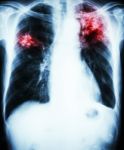 Pulmonary Tuberculosis Stock Photo