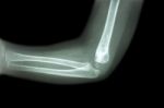 Film X-ray Of Child 's Elbow ( Normal Child 's Elbow ) ( Side View , Lateral ) Stock Photo