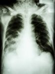 Pneumonia With Respiratory Failure Stock Photo