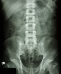 Normal Human's Lumbosacral Spine Stock Photo