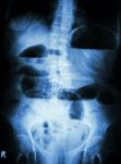 Small Bowel Obstruction.  Film X-ray Abdomen Upright :  Show Small Bowel Dilated And Air-fluid Level In Small Bowel Due To Small Bowel Obstruction Stock Photo