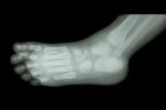 Film X-ray Of Child 's Foot ( Side View ) ( Lateral ) Stock Photo