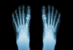 Film X-ray Both Foot ( Front View ) Stock Photo