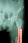 Film X-ray Fracture Femur(thigh Bone). It Was Operated And Inter Stock Photo