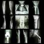 Collection Of Orthopedic Operation Stock Photo
