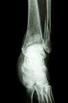 Fracture Distal Tibia And Fibula (leg's Bone) Stock Photo