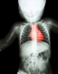 Film X-ray Whole Child 's Body With Heart Disease ( Rheumatic Heart Disease , Valvular Heart Disease ) ( Cardiovascular System ) Stock Photo