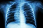 Pulmonary Tuberculosis ( Chest X-ray Of Child : Show Patchy Infiltration At Right Middle Lung ) Stock Photo