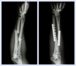 Fracture Both Bone Of Forearm. It Was Operated And Internal Fixed With Plate And Screw (left Image : Before Operation , Right Image : After Operation) Stock Photo