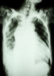 Pulmonary Tuberculosis And Right Lung Effusion Stock Photo