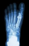 Fracture Proximal Phalange At First Toe Stock Photo