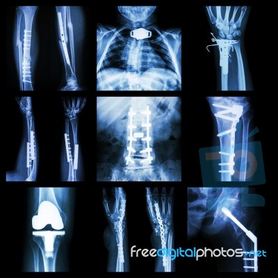 collection of orthopedic operation stock photo royalty free image id 100415775 freedigitalphotos net