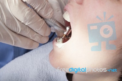 Dental Cleaning Close-up Stock Photo