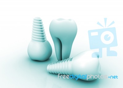 Dental Implant Stock Image