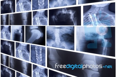 Group Of X-rays On Light Board Stock Photo