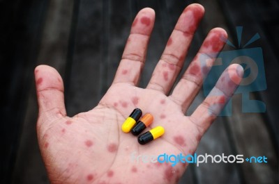 Illness Hand(scarlet Fever) With Drug Stock Photo