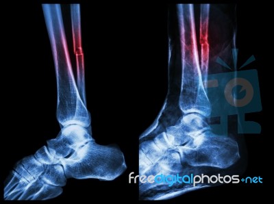 Left Image : Fracture Shaft Of Fibula (calf Bone)  ,  Right Image : It Was Splinted With Plaster Cast Stock Photo