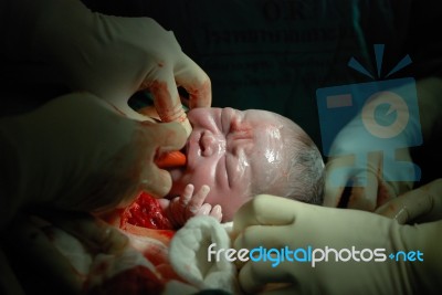 New Born Infant In The Operation Room Stock Photo