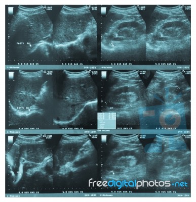 Ultrasonography Image Of Abdomen Stock Photo