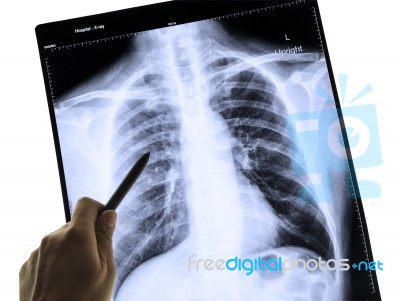 X-ray Human Chest For A Medical Diagnosis And Hand Poin Stock Photo