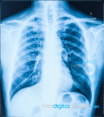 X-ray Image Of Human Chest For A Medical Diagnosis Stock Photo