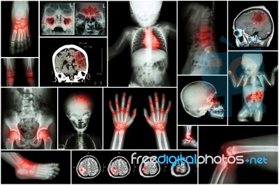 X-ray Multiple Part Of Child 's Body & Multiple Disease ( Stroke , Brain Tumor , Rheumatoid Arthritis , Sinusitis , Gouty Arthritis , Etc)( Skull Chest Lung Heart Spine Arm Hand Pelvis Leg Knee Foot ) Stock Photo
