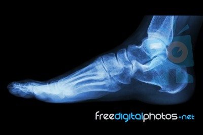 X-ray Normal Human's Foot Lateral Stock Photo