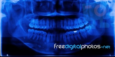 X-ray Teeth Stock Photo