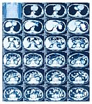 Medical Diagnosis Background. Ct Scan Stock Photo