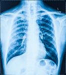 X-ray Image Of Human Chest For A Medical Diagnosis Stock Photo