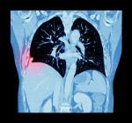 Lung Cancer ( Ct Scan Of Chest And Abdomen : Show Right Lung Cancer ) ( Coronal Plane ) Stock Photo