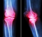 Osteoarthritis Knee .  Film X-ray Knee ( Anterior - Posterior And Lateral View )  Show Narrow Joint Space , Osteophyte ( Spur ) , Subcondral Sclerosis Due To Degenerative Change Stock Photo
