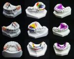 Dental Braces Stock Photo
