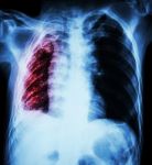 Pulmonary Tuberculosis .   Chest X-ray : Right Lung Atelectasis Stock Photo