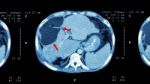 Ct Scan Of Upper Abdomen : Show Abnormal Mass At Liver ( Liver Cancer ) Stock Photo
