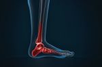 Arthritis Of Ankle. X-ray Of Foot. Lateral View Stock Photo