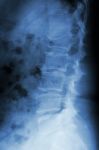 Film X-ray Lumbar Spine Lateral : Show Burst Fracture At Lumbar Stock Photo