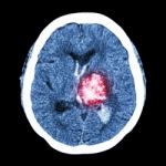 Ct Brain : Show Left Thalamic Hemorrhage (hemorrhagic Stroke) Stock Photo