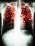 Mycobacterium Tuberculosis Infection (pulmonary Tuberculosis) Stock Photo