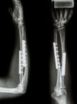 Fracture Shaft Of Radius & Ulnar Bone. It Was Operated And Inter Stock Photo