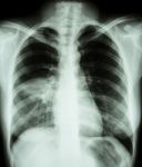 Pneumonia ( Film Chest X-ray Show Alveolar Infiltrate At Right Middle Lung ) ( Image For Pulmonary Tuberculosis , Mers-cov , Sars ) Stock Photo