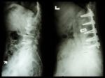 "spondylosis" (left Image) , Patient Was Operated And Internal Fixed. (right Image) In Old Man"spondylosis" (left Image) , Patient Was Operated And Internal Fixed. (right Image) In Old Man Stock Photo