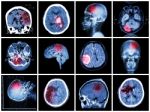 Collection Of Brain Disease ( Ct Scan And Mri Of Brain : Show Cerebral Infarct , Intracerebral Hemorrhage , Brain Tumor , Basal Ganglia Hemorrhage ( Status Post Craniotomy ) ) ( Health Care Concept ) Stock Photo