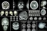 Set , Collection Of Brain Disease ( Cerebral Infarction , Hemorrhagic Stroke , Brain Tumor , Disc Herniation With Spinal Cord Compression ,etc)( Ct Scan , Mri , Mrt )( Neurology And Nervous System ) Stock Photo