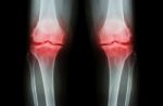 Osteoarthritis Knee ( Oa Knee ). Film X-ray Both Knee ( Front View ) Show Narrow Joint Space ( Joint Cartilage Loss ) , Osteophyte , Subchondral Sclerosis Stock Photo