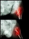 Fracture Head Of Femur(thigh Bone) (intertrochanteric Fracture)  (2 Position) Stock Photo