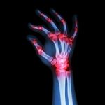 "rheumatoid Arthritis , Gouty Arthritis"  (x-ray Adult's Hand With Multiple Arthritis) Stock Photo