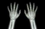Film X-ray Normal Both Hands Of Child Stock Photo