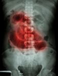"small Intestine Obstruction"  Film X-ray Abdomen Supine : Show Stock Photo
